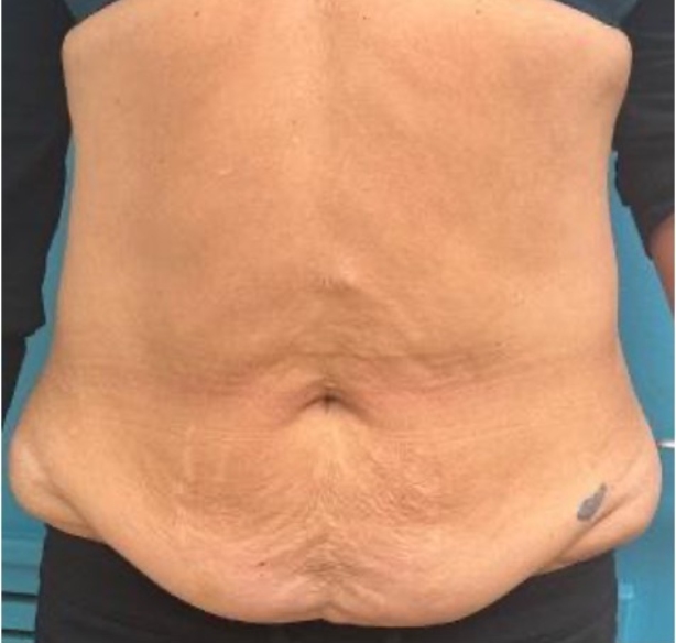 Before abdominoplasty showing abdominal fullness and excess skin, front view