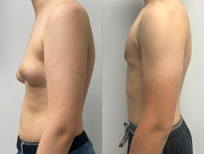 before and after photo after Male Aesthetics/Gynecomastia procedure