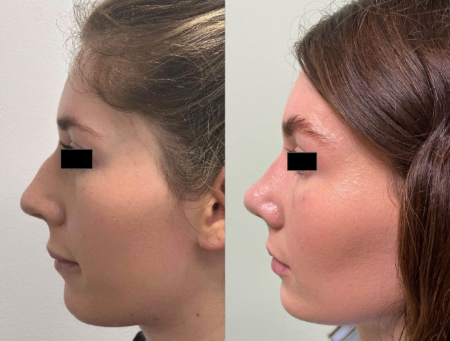 woman Before and after rhinoseptoplasty