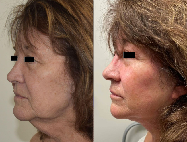 woman Before and after face/neck lift and blepharoplasty