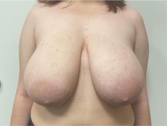 Before breast reduction showing the breasts prior to surgery, front view