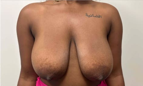 Before breast reduction showing the breasts prior to surgery, front view