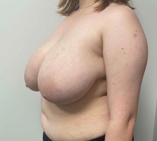 Before breast reduction showing the breasts prior to surgery, left oblique view