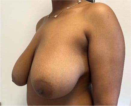 Before breast reduction showing the breasts prior to surgery, left oblique view