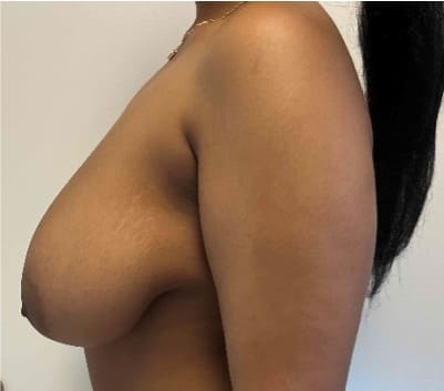 Before breast reduction showing the breasts prior to surgery, left side view