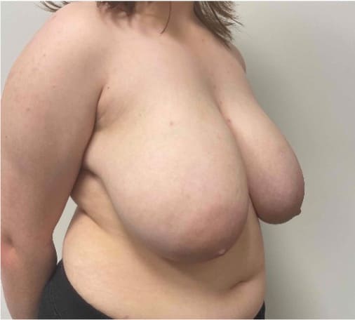 Before breast reduction showing the breasts prior to surgery, right oblique view