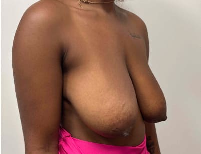 Before breast reduction showing the breasts prior to surgery, right oblique view
