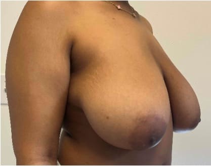 Before breast reduction showing the breasts prior to surgery, right oblique view