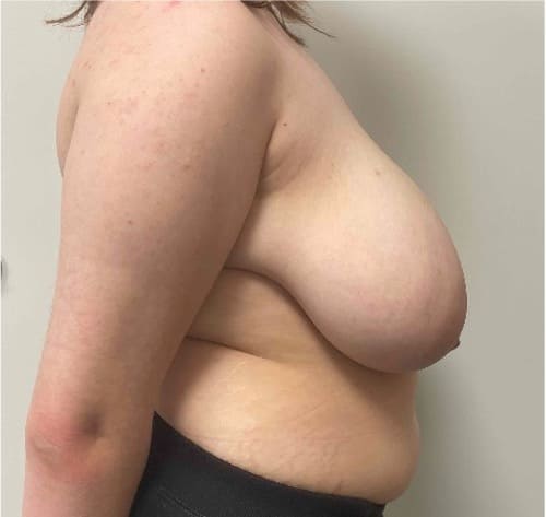 Before breast reduction showing the breasts prior to surgery, right side view