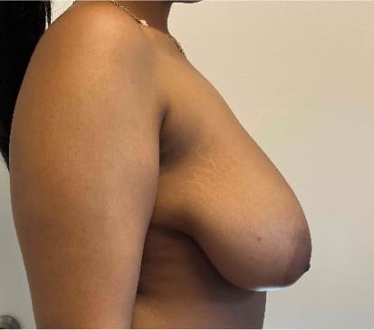 Before breast reduction showing the breasts prior to surgery, right side view
