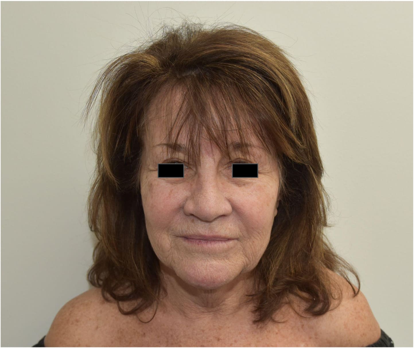 Before face and neck lift with blepharoplasty showing facial aging, neck laxity, and excess upper eyelid skin, front view
