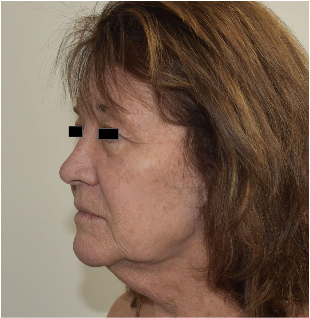 Before face and neck lift with blepharoplasty showing facial aging, neck laxity, and excess upper eyelid skin, left oblique view