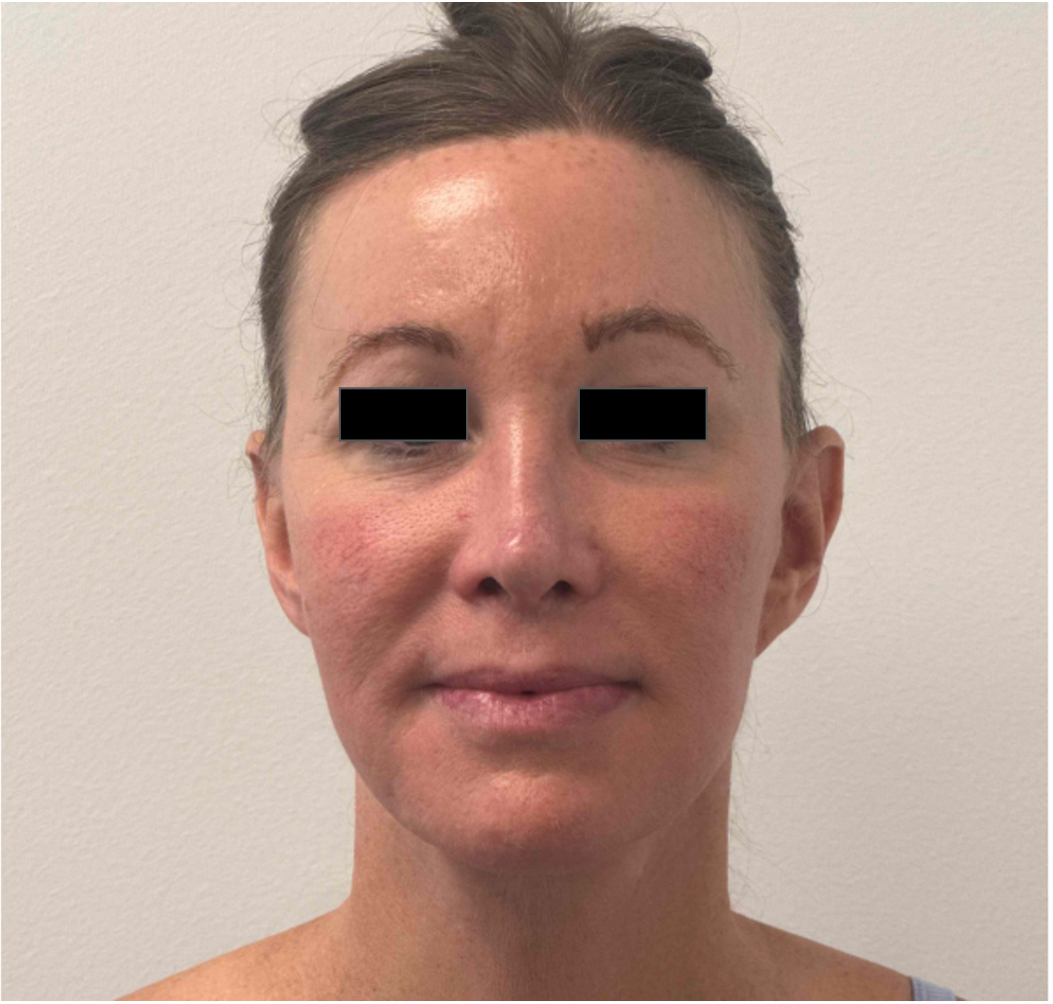 Before face and neck lift showing facial aging, loss of jawline definition and neck laxity, front view