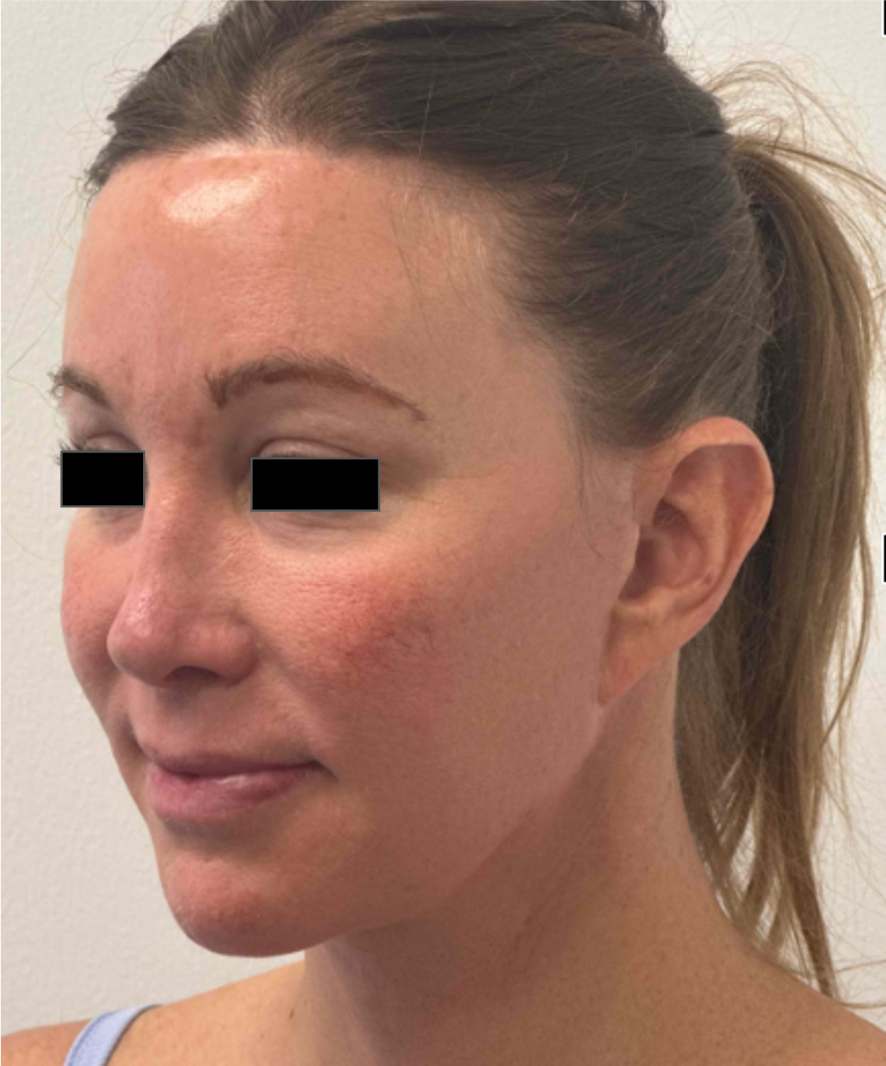 Before face and neck lift showing facial aging, loss of jawline definition and neck laxity, left oblique view