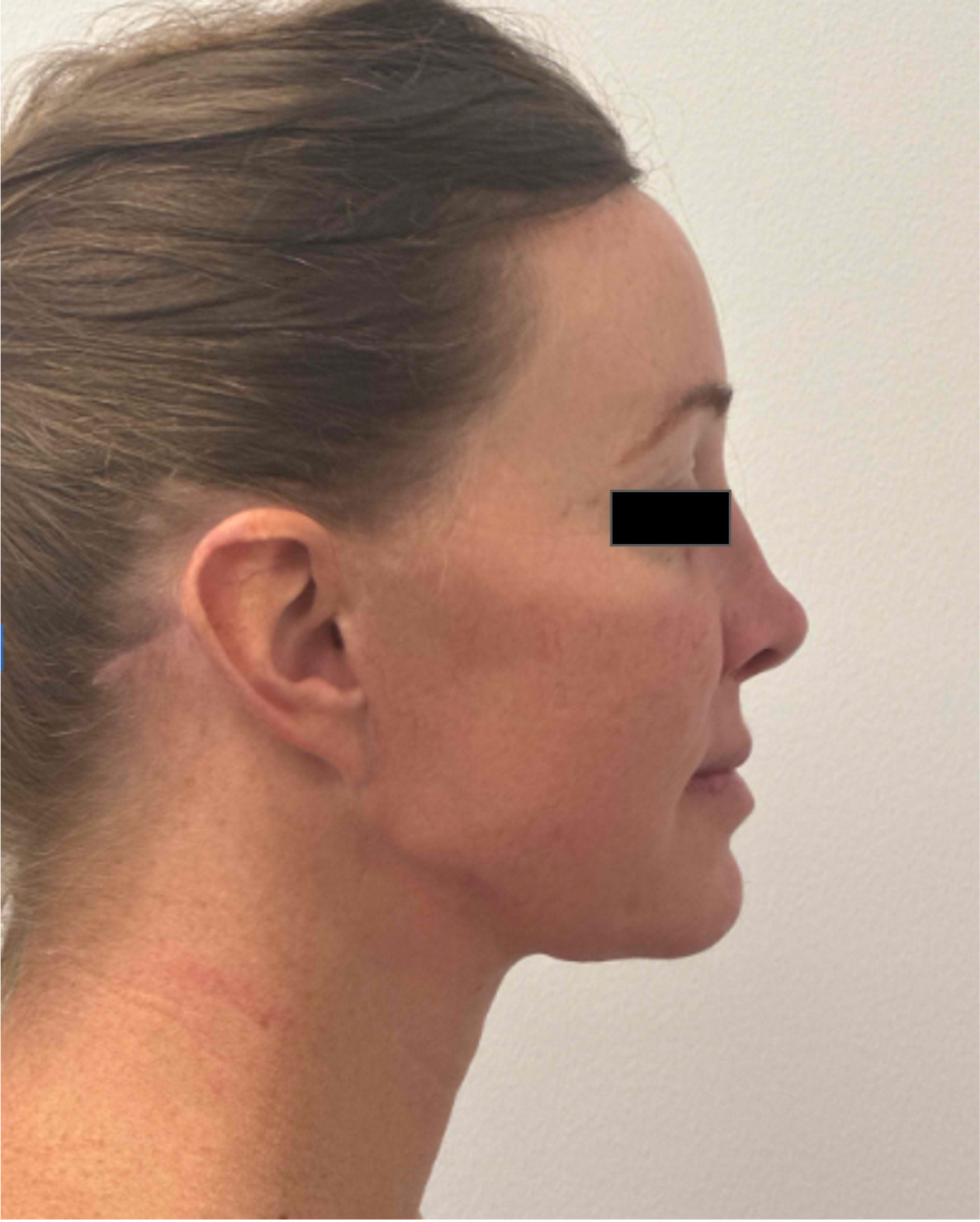 Before face and neck lift showing facial aging, loss of jawline definition and neck laxity, right side view