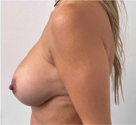 Before implant exchange showing breast with less natural contour and fuller upper outer chest volume, left side view
