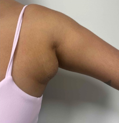 Before left axillary breast tissue removal showing excess tissue in the underarm area