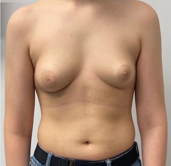 Before male gynecomastia surgery showing excess breast tissue and a less defined chest contour, front view
