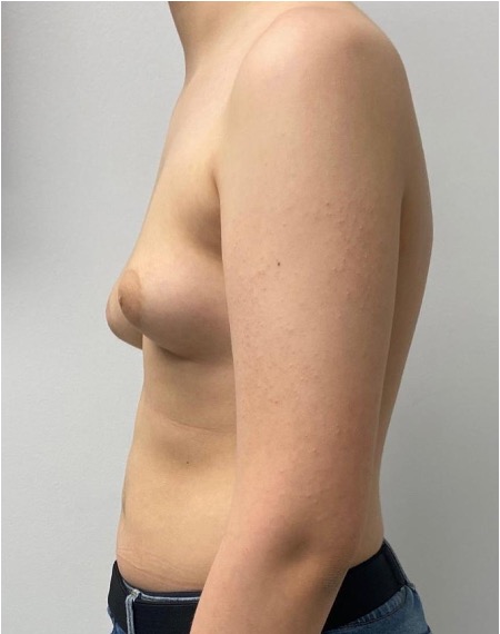 Before male gynecomastia surgery showing excess breast tissue and a less defined chest contour, left side view