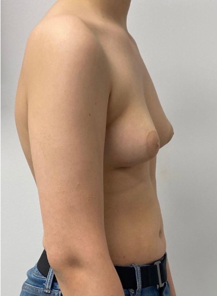Before male gynecomastia surgery showing excess breast tissue and a less defined chest contour, right oblique view