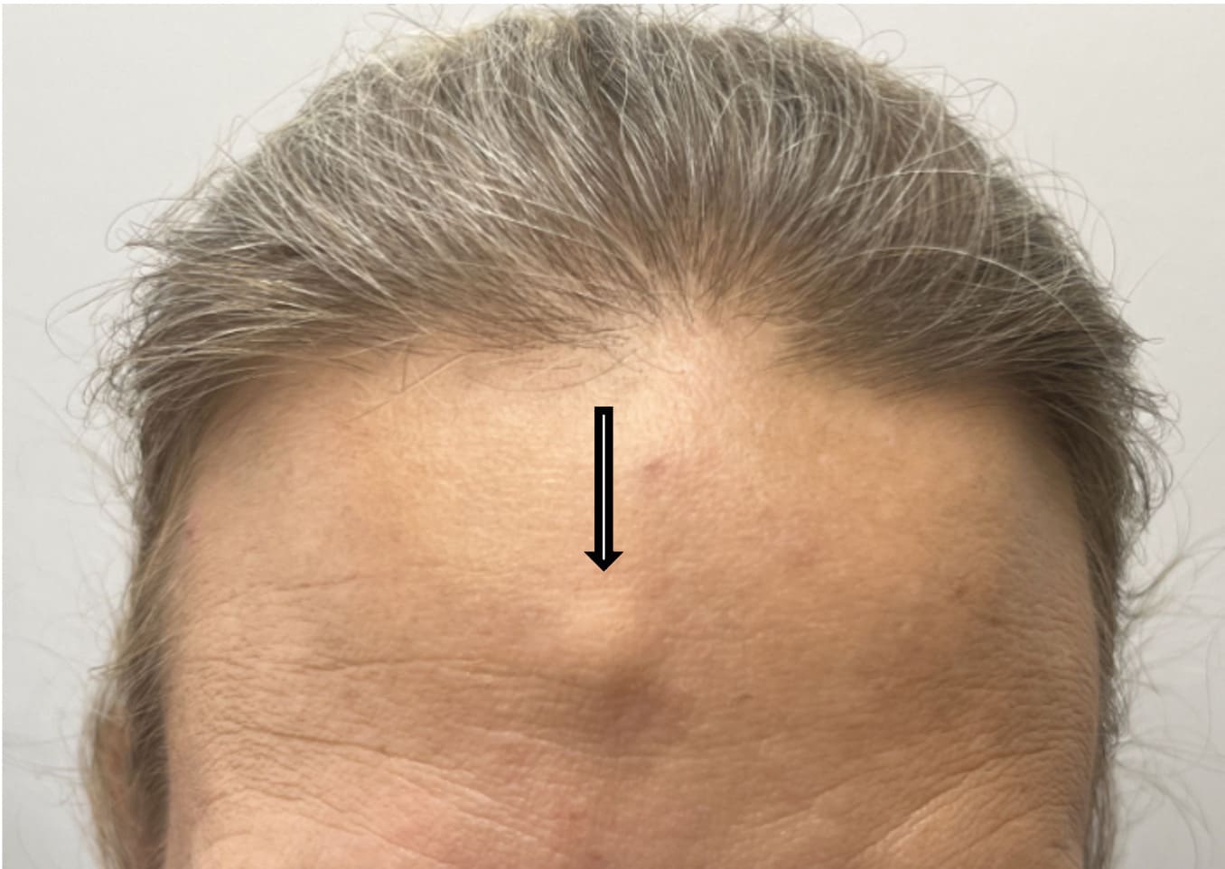 Before male gynecomastia surgery showing excess breast tissue and a less defined chest contour.