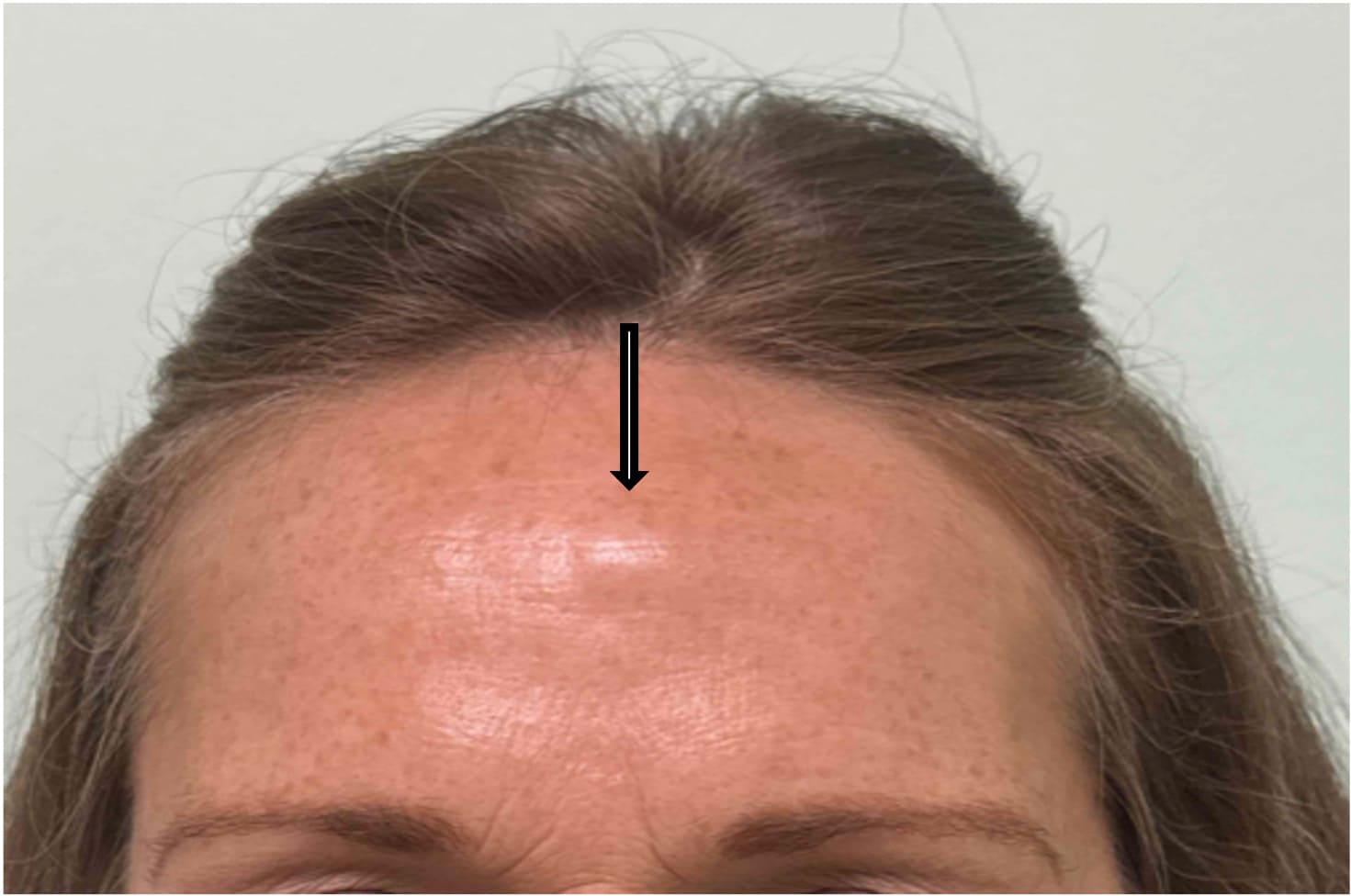Before osteoma removal showing a prominent forehead osteoma and uneven forehead contour, front view