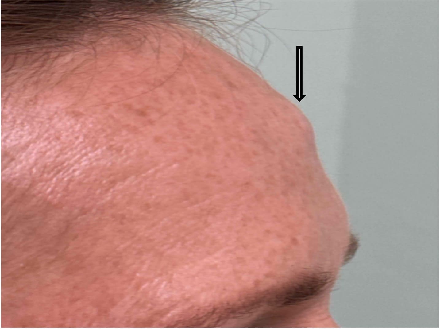 Before osteoma removal showing a prominent forehead osteoma and uneven forehead contour, right oblique view