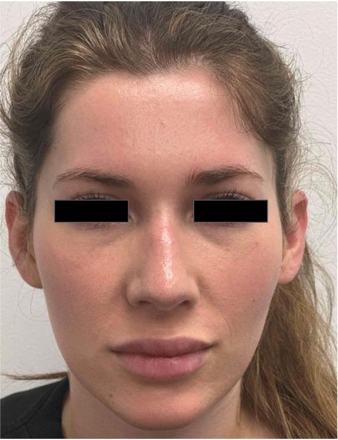Before rhinoseptoplasty showing a deviated septum and nasal shape concerns.