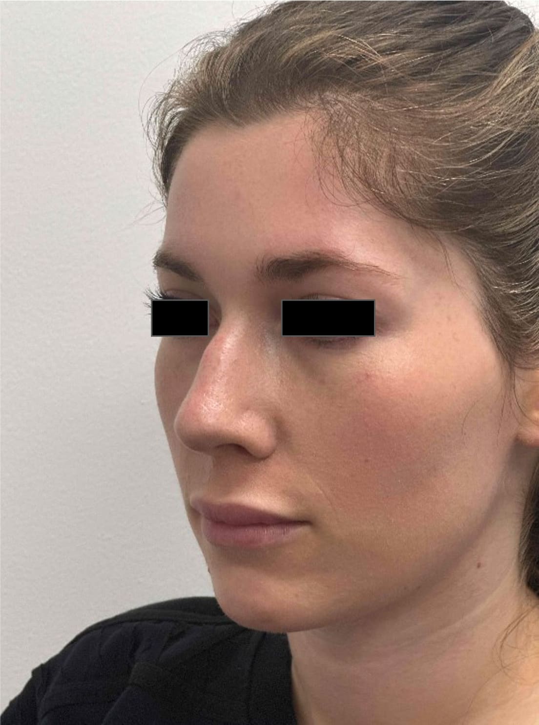 Before rhinoseptoplasty showing a deviated septum and nasal shape concerns, left oblique view