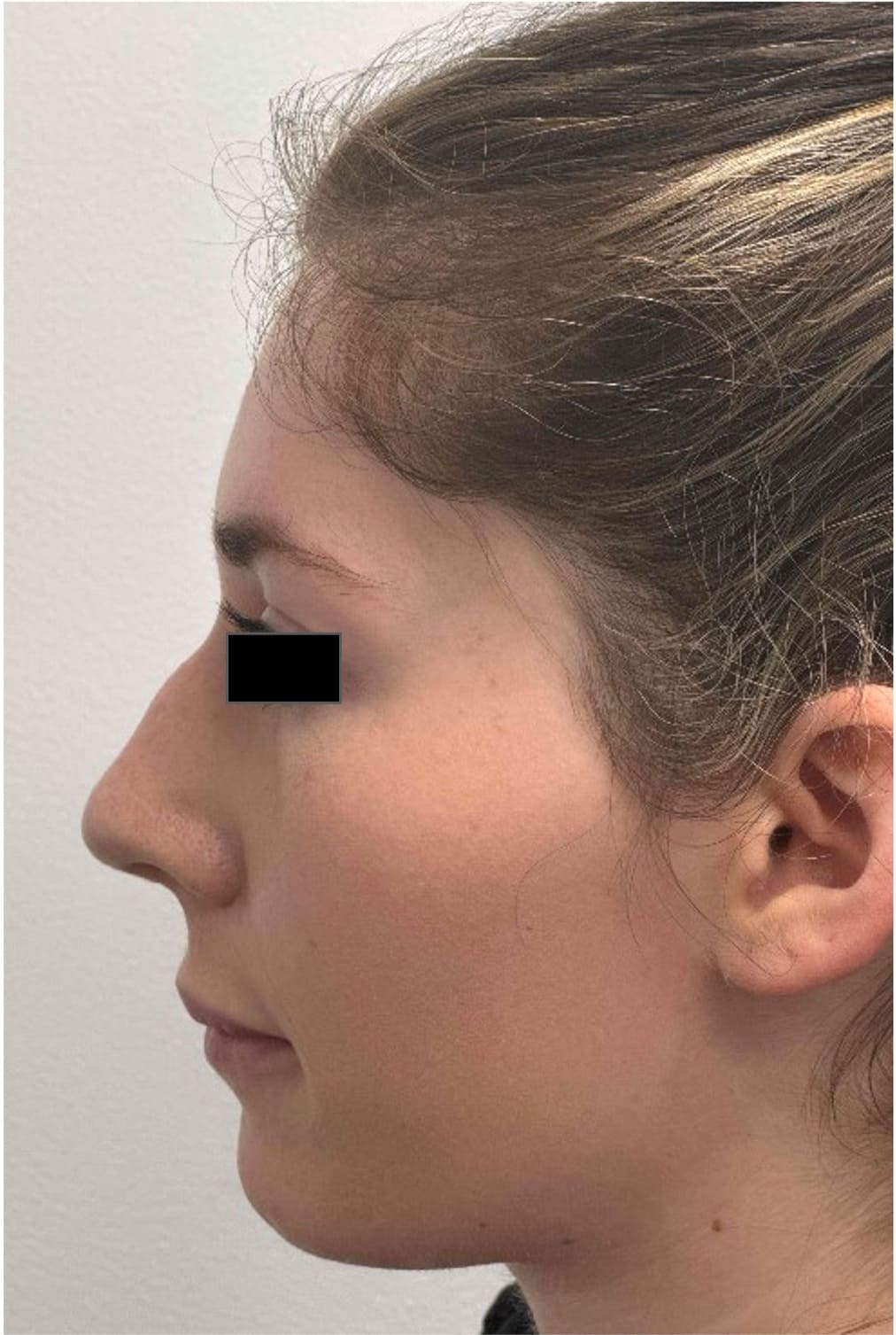 Before rhinoseptoplasty showing a deviated septum and nasal shape concerns, left side view