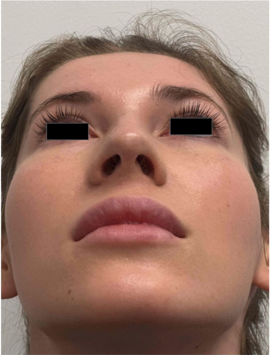 Before rhinoseptoplasty showing a deviated septum and nasal shape concerns, base view