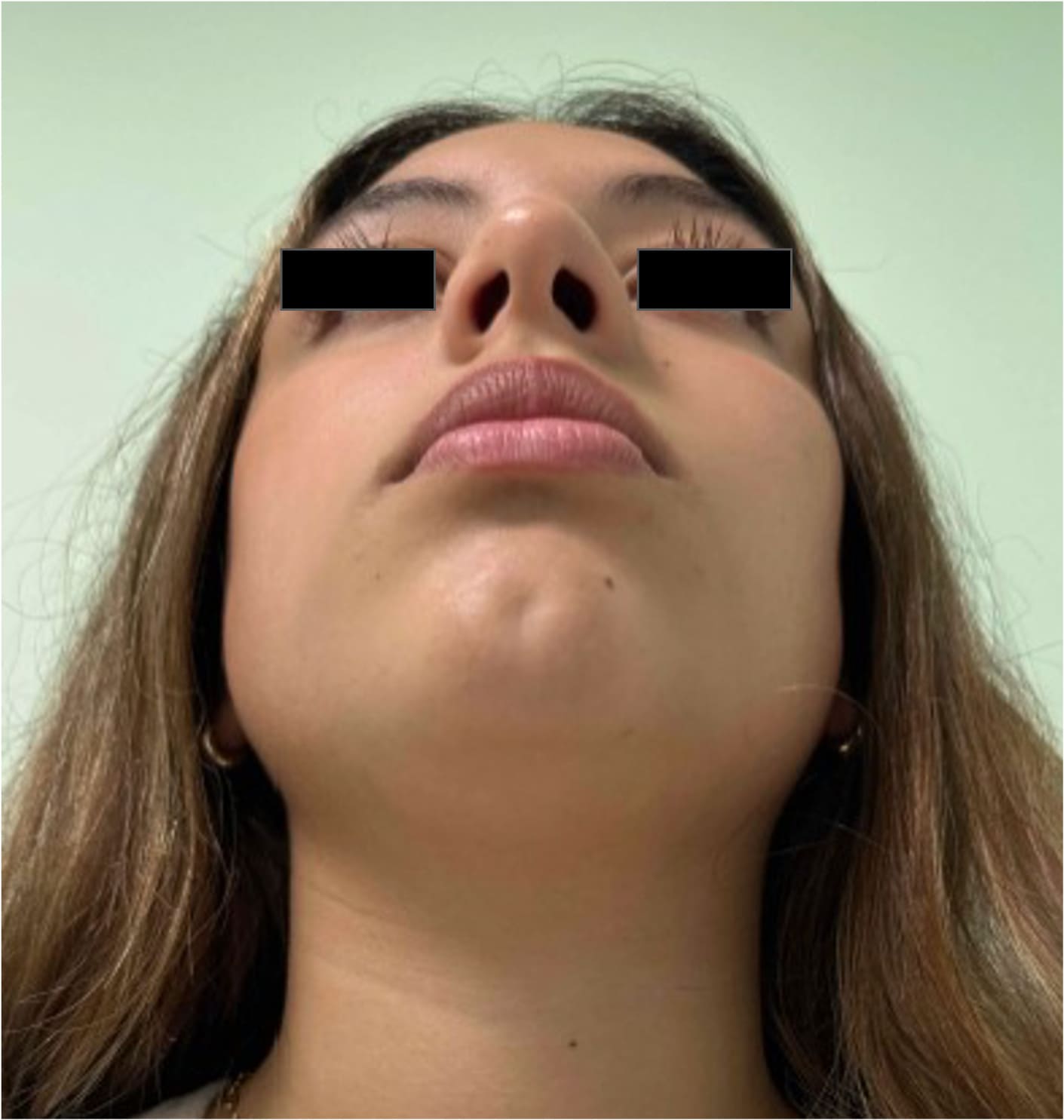 Before rhinoseptoplasty showing nasal asymmetry and a deviated septum, base view
