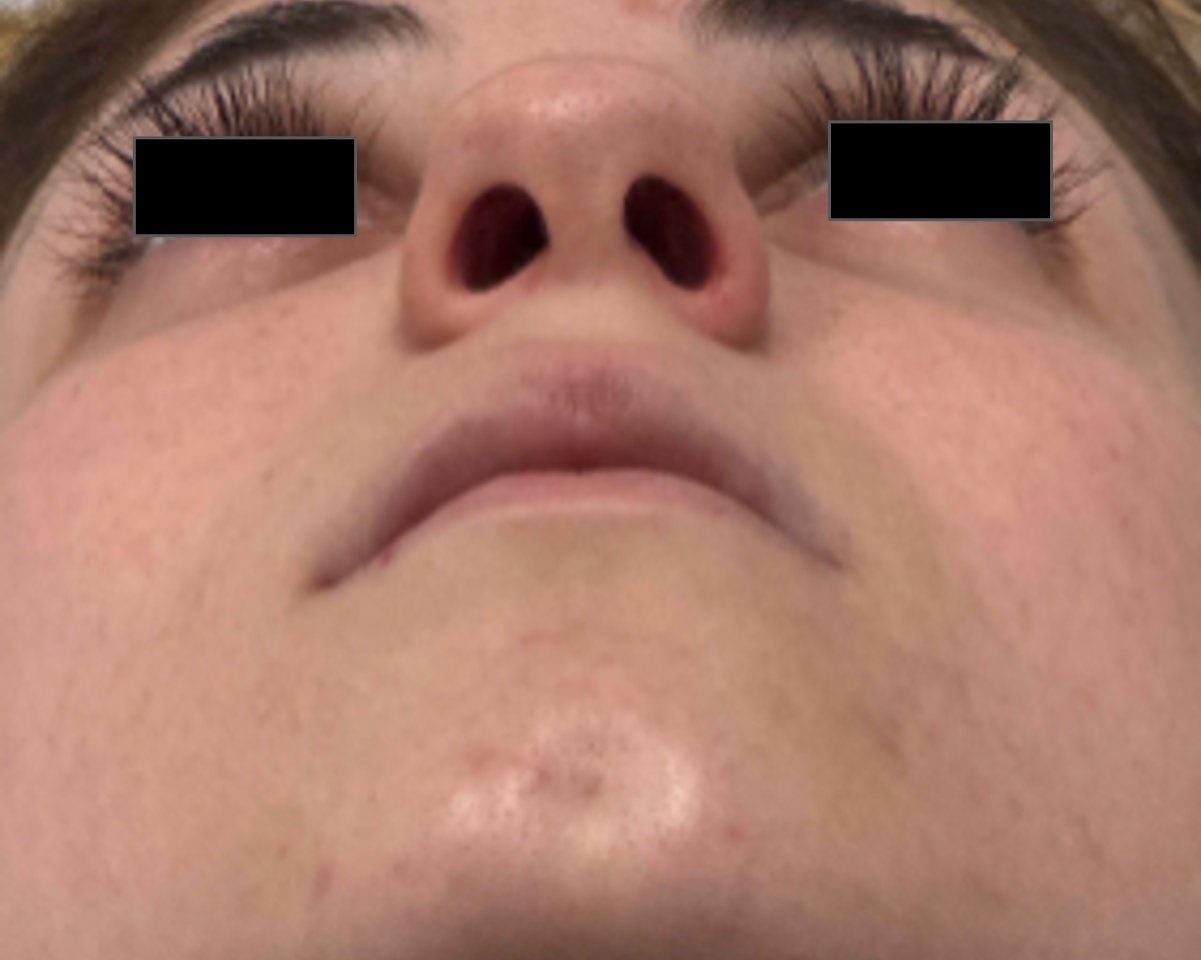 Before rhinoseptoplasty showing the nose prior to surgery,base view