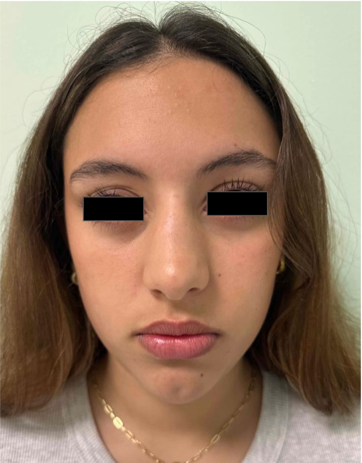 Before rhinoseptoplasty showing nasal asymmetry and a deviated septum, front view