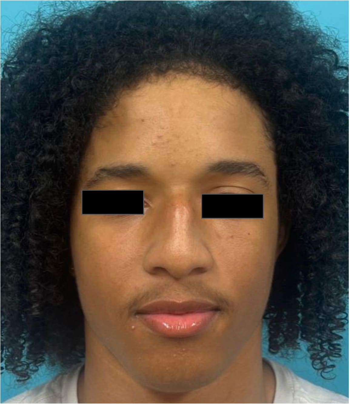 Before rhinoseptoplasty showing the nose prior to surgery, front view