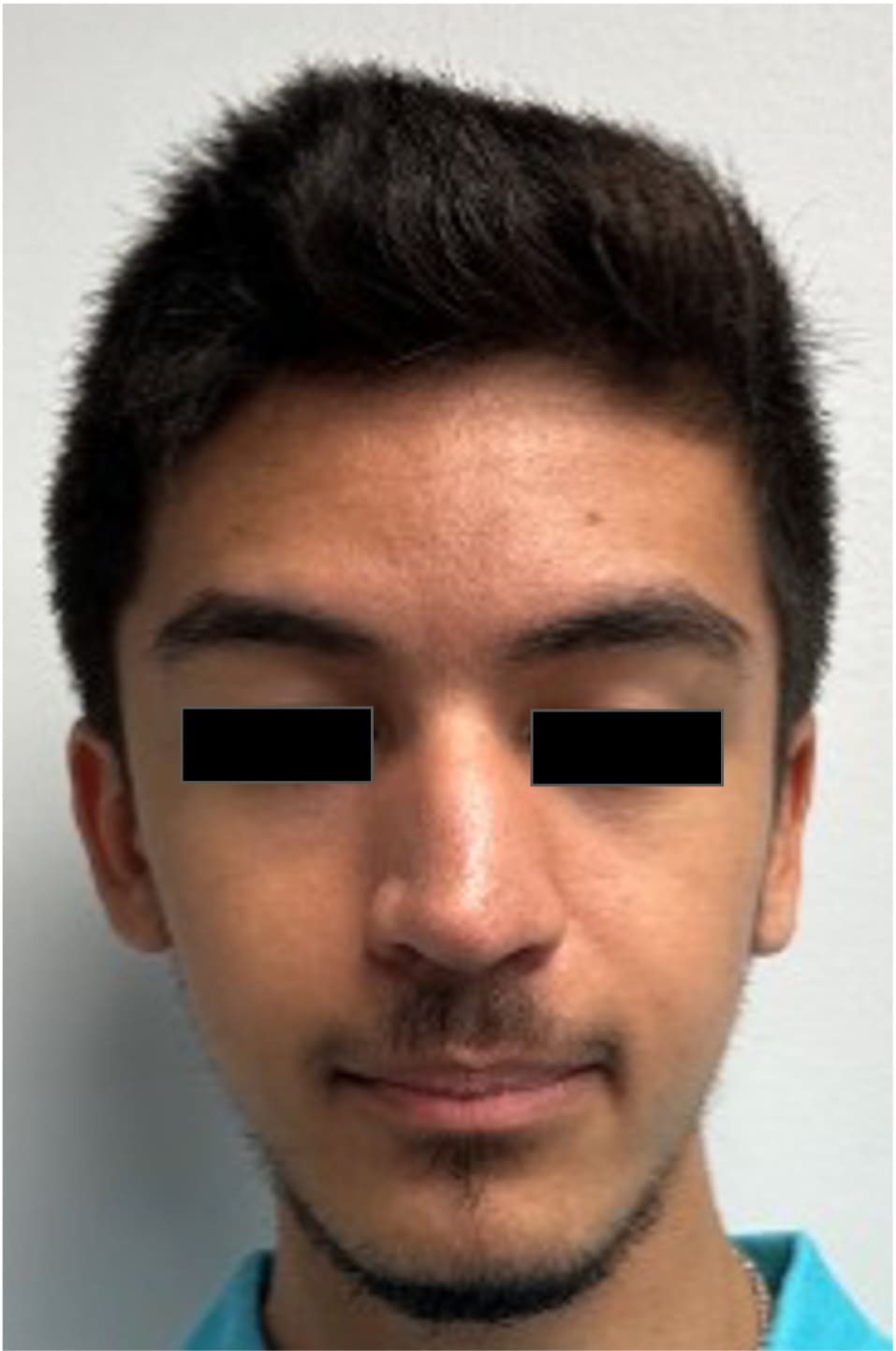 Before rhinoseptoplasty showing the nose prior to surgery, front view