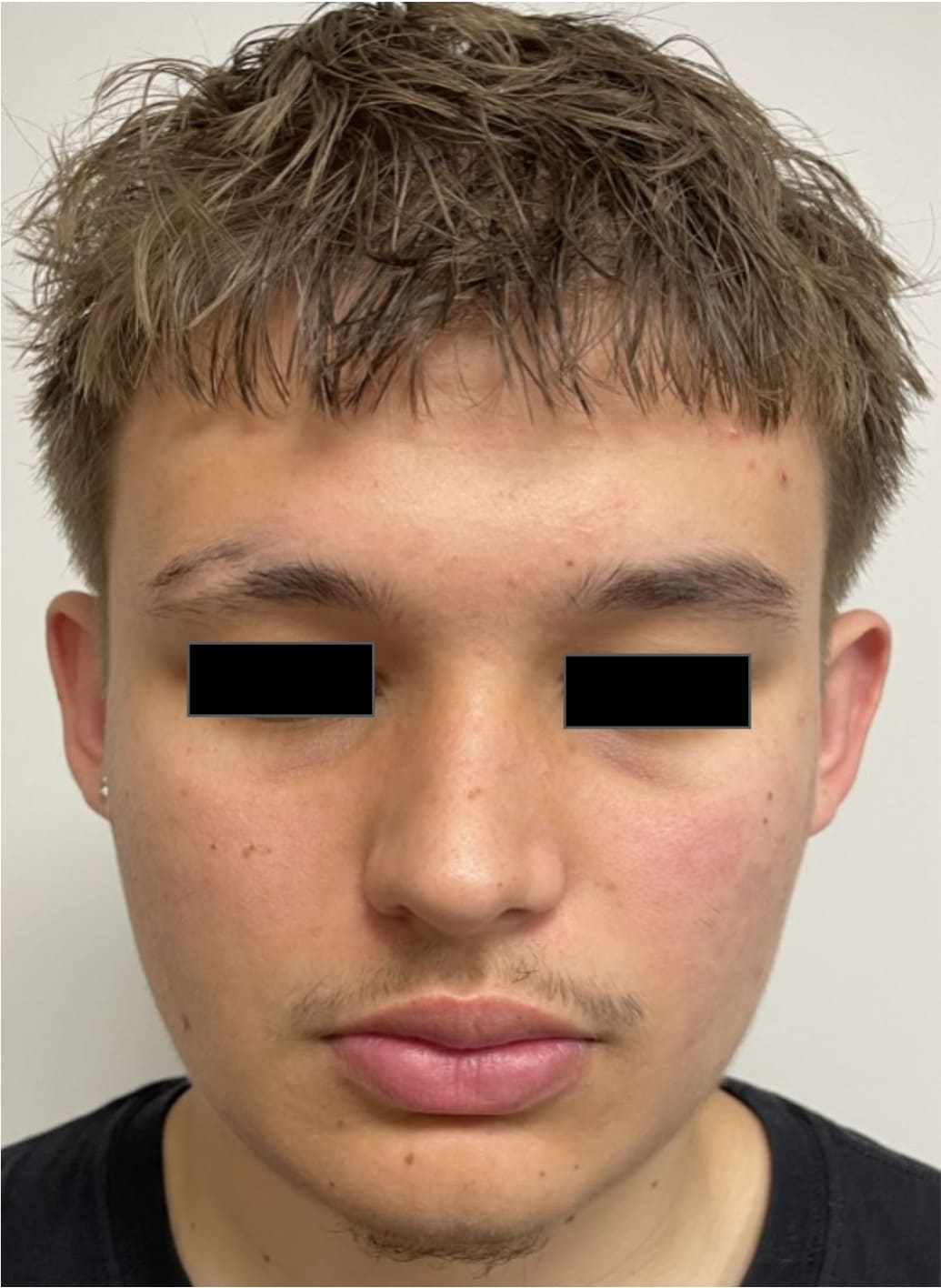 Before rhinoseptoplasty showing the nose prior to surgery, front view