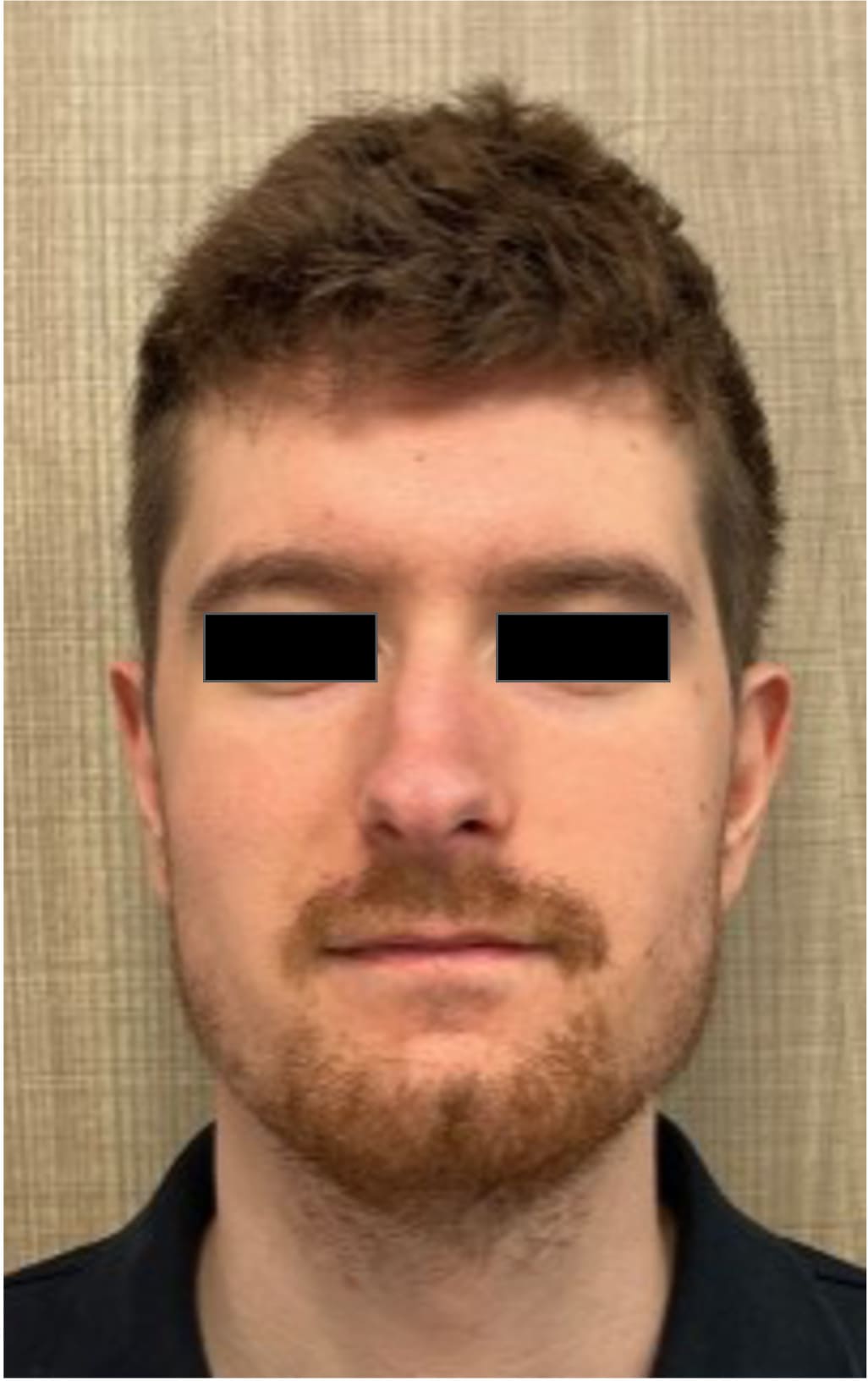 Before rhinoseptoplasty showing the nose prior to surgery, front view
