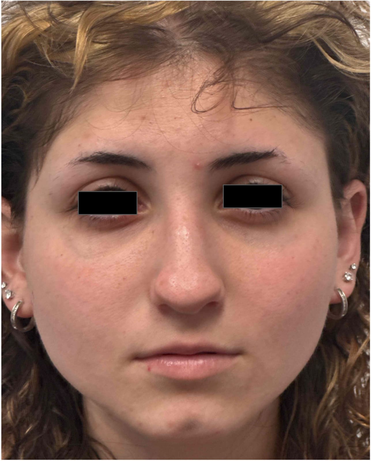 Before rhinoseptoplasty showing the nose prior to surgery, front view