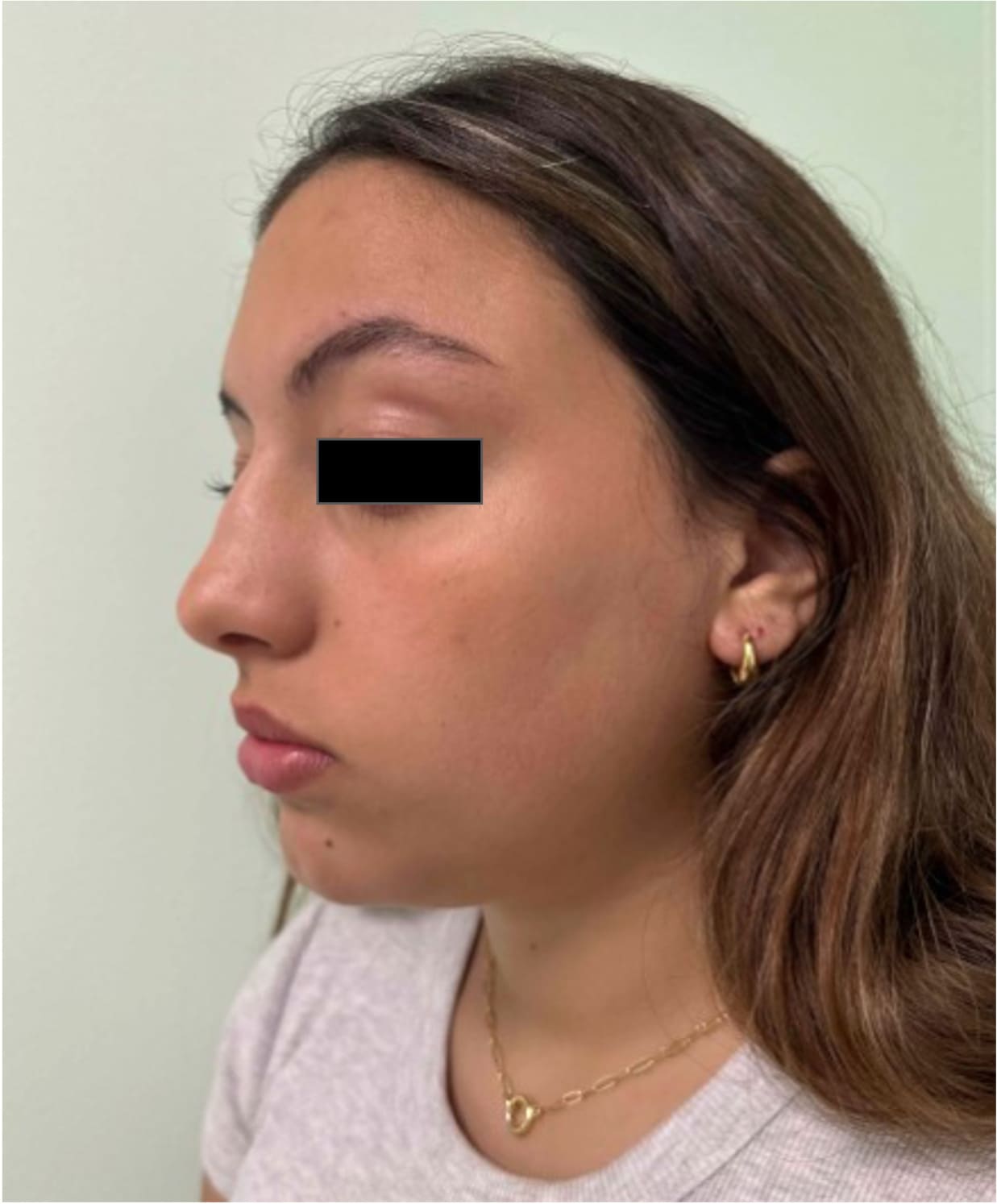 Before rhinoseptoplasty showing nasal asymmetry and a deviated septum, left oblique view