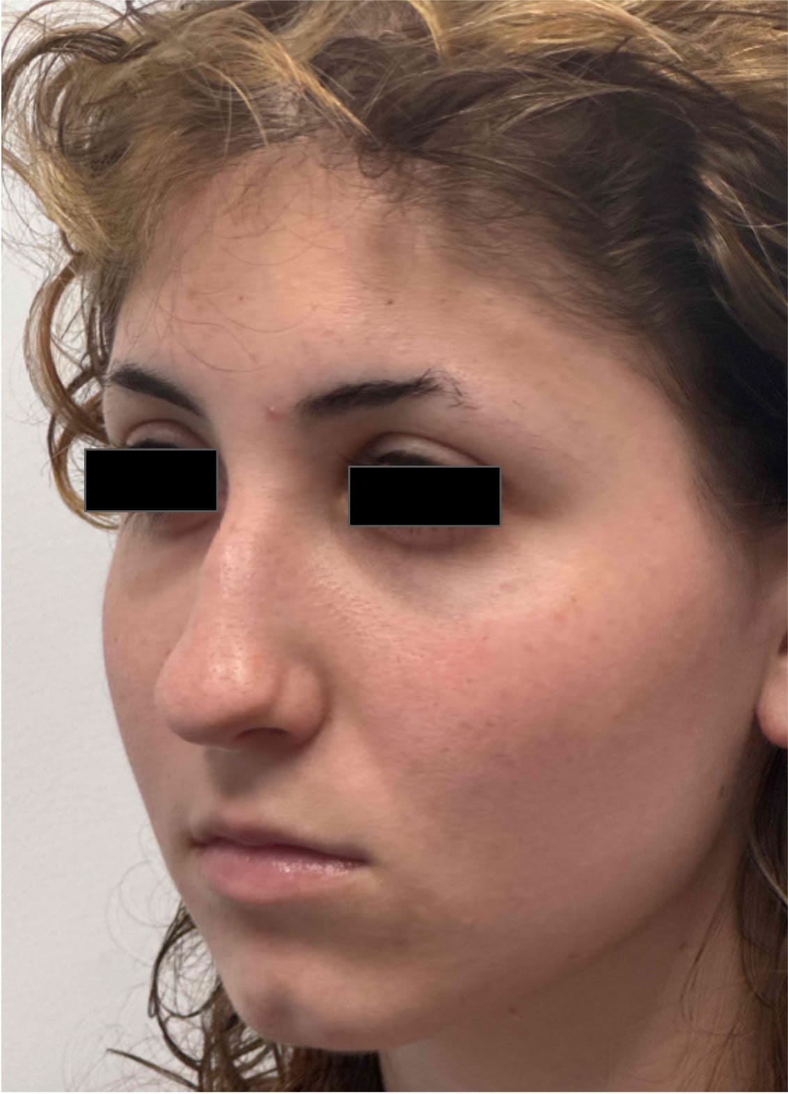Before rhinoseptoplasty showing the nose prior to surgery, left oblique view