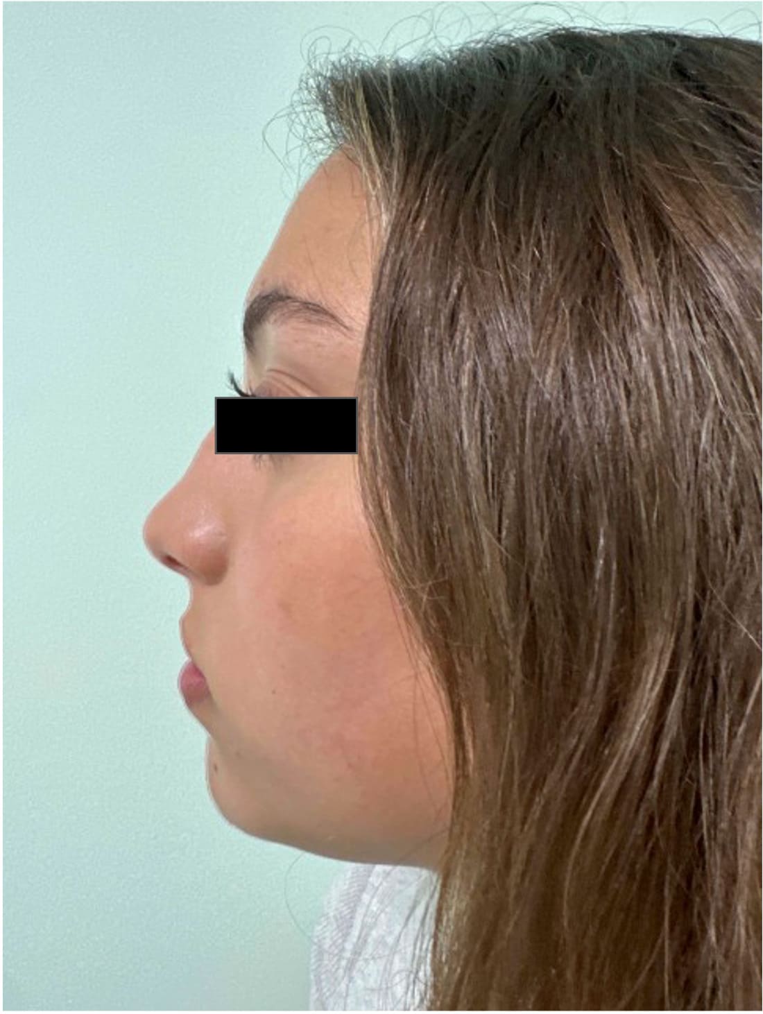 Before rhinoseptoplasty showing nasal asymmetry and a deviated septum, left side view