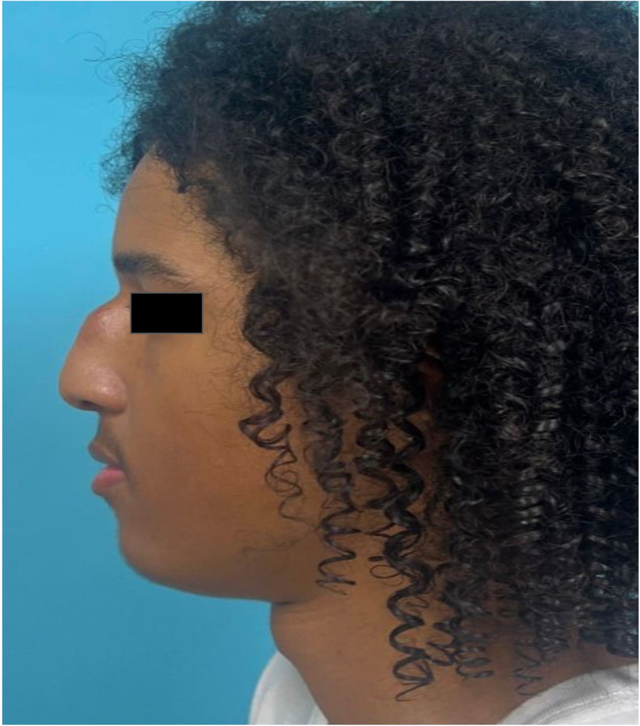 Before rhinoseptoplasty showing the nose prior to surgery, left side view