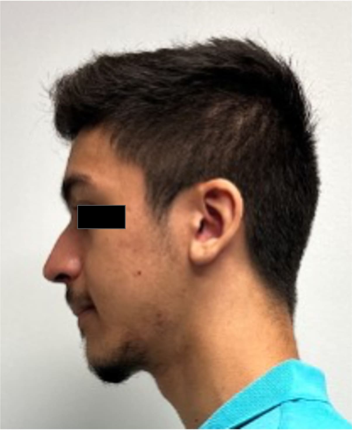 Before rhinoseptoplasty showing the nose prior to surgery, left side view