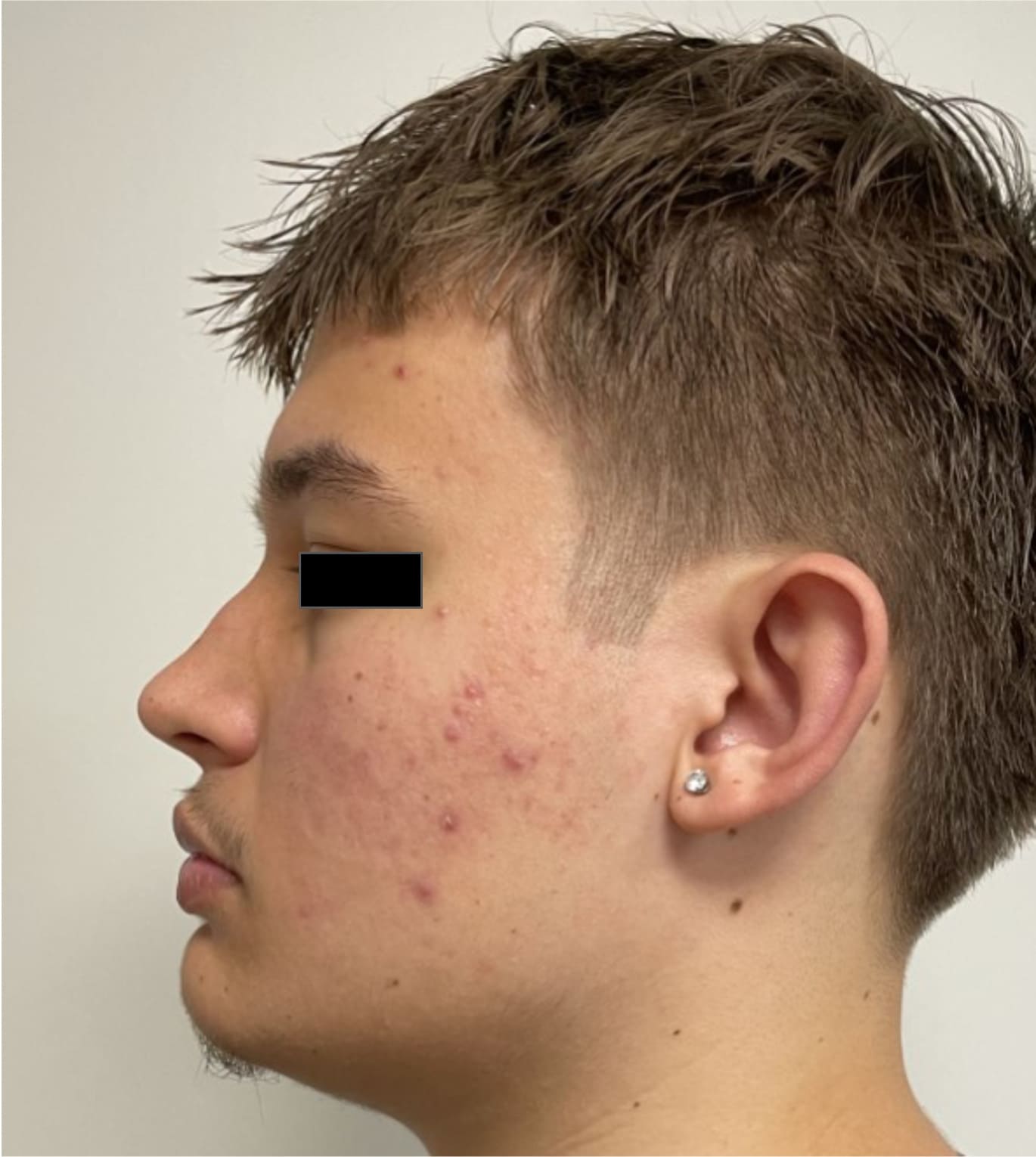 Before rhinoseptoplasty showing the nose prior to surgery, left side view
