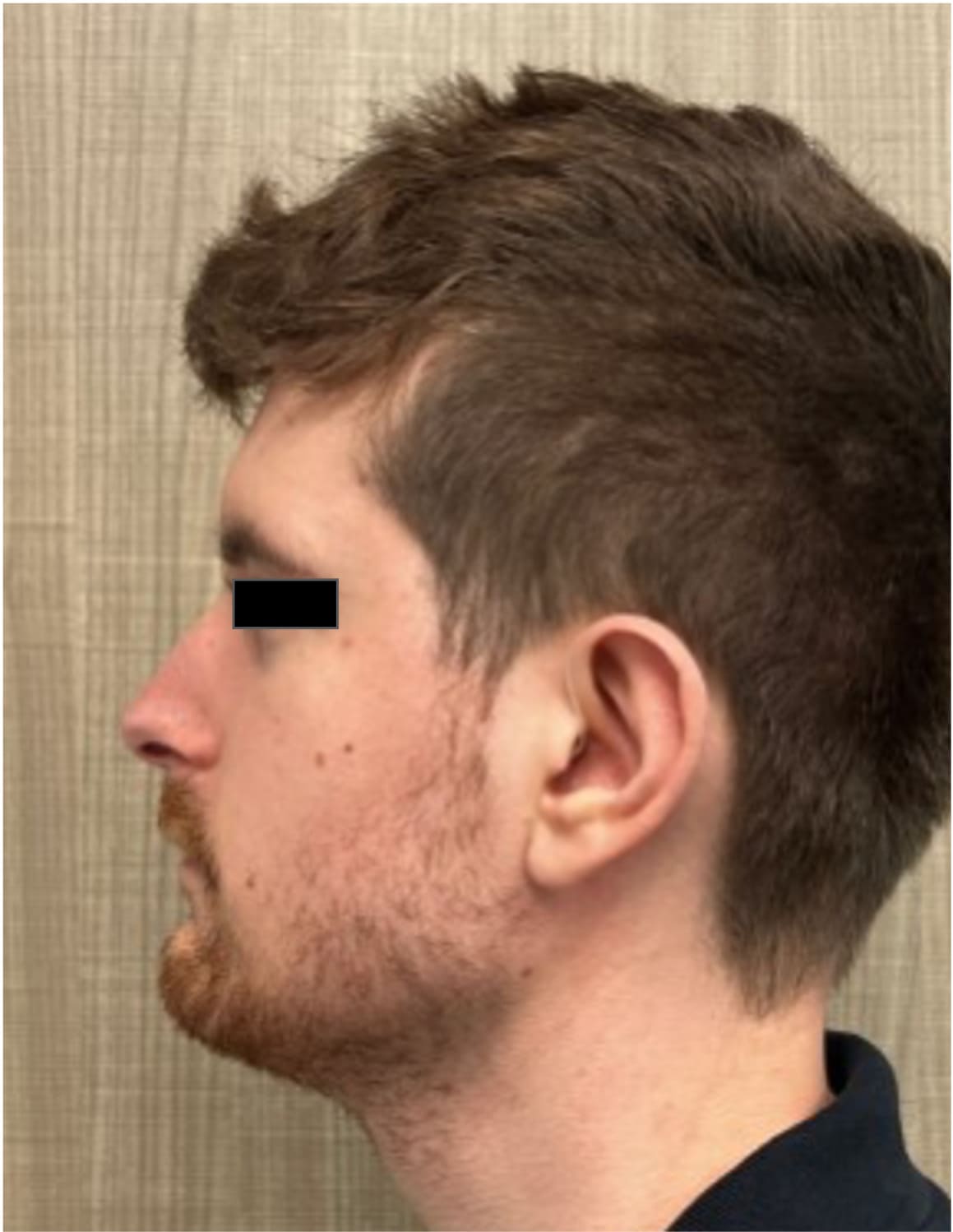 Before rhinoseptoplasty showing the nose prior to surgery, left side view