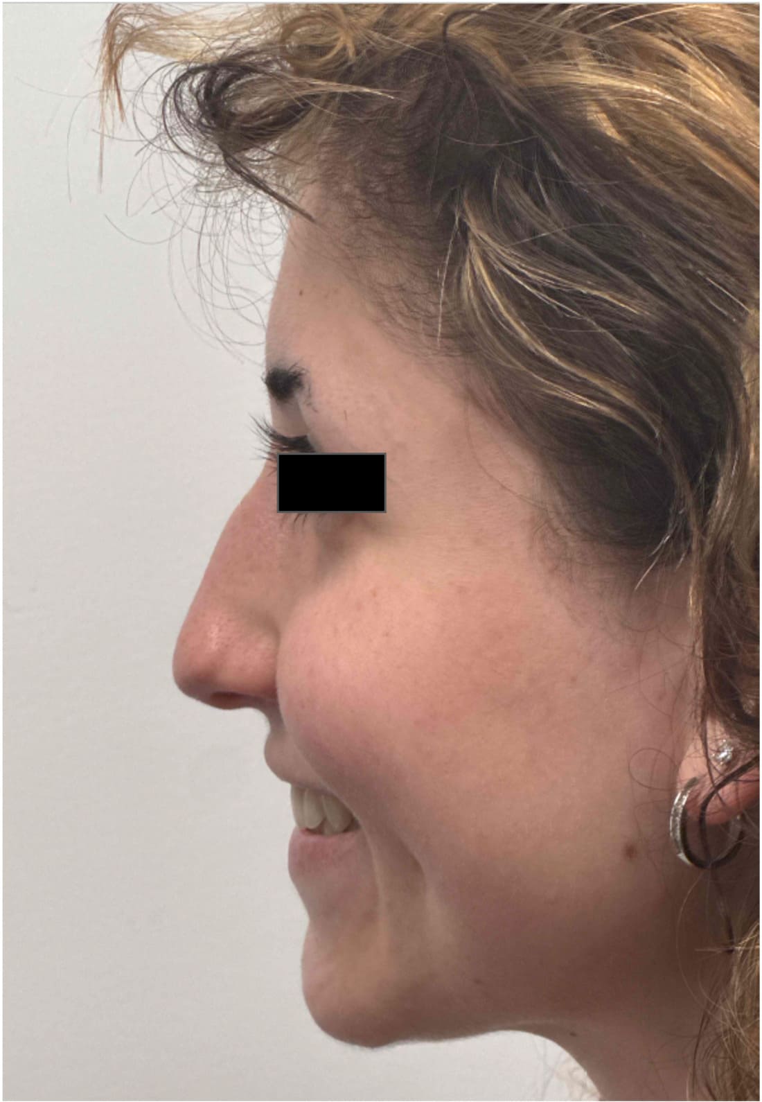 Before rhinoseptoplasty showing the nose prior to surgery, left side view