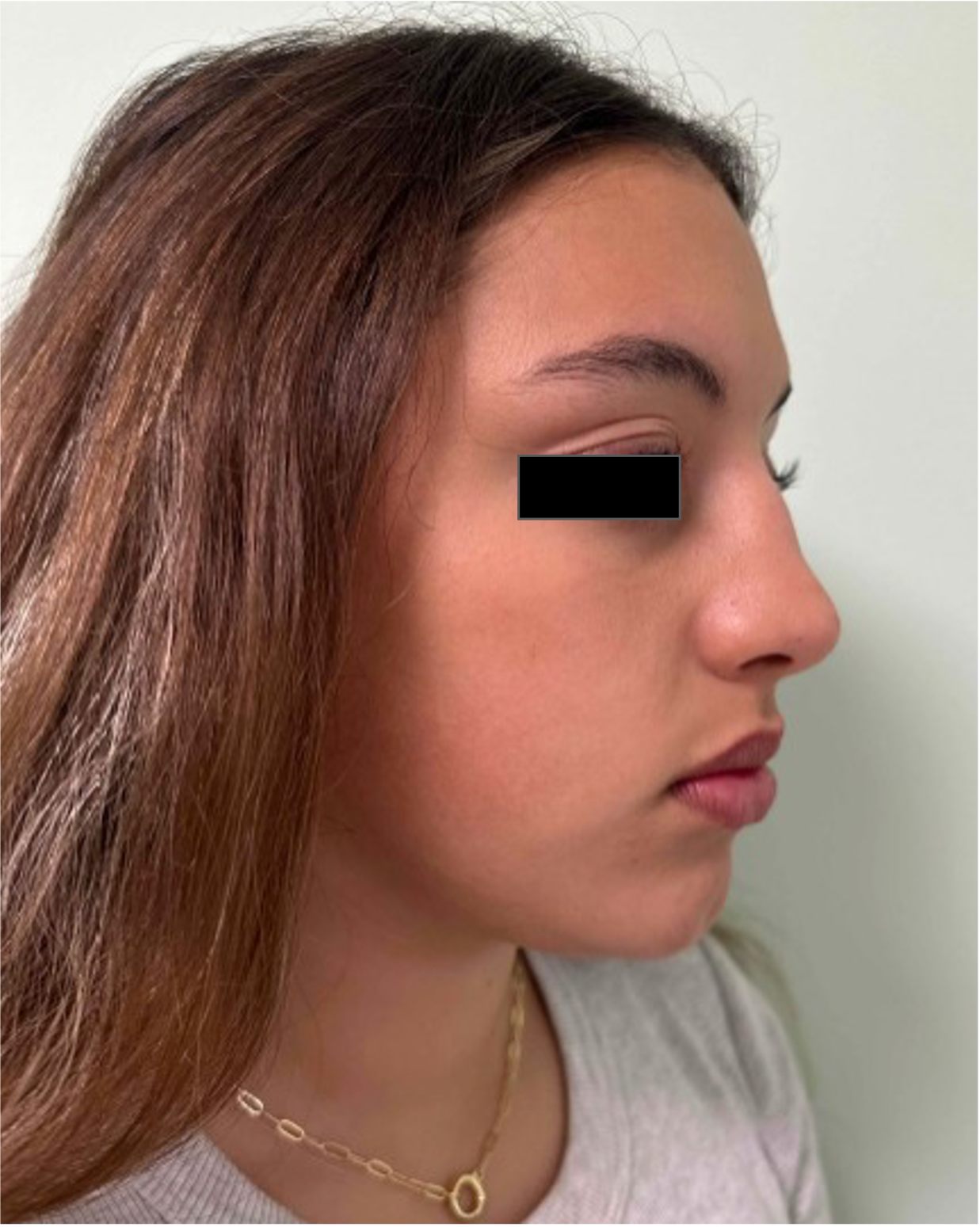 Before rhinoseptoplasty showing nasal asymmetry and a deviated septum, right oblique view