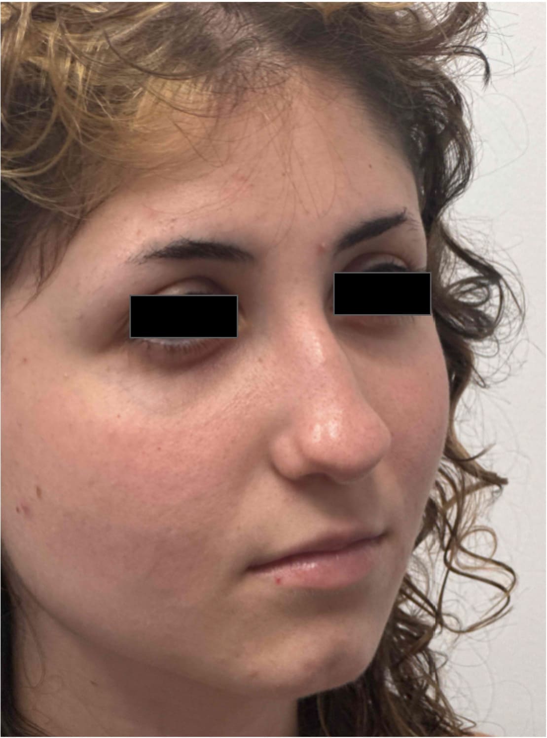 Before rhinoseptoplasty showing the nose prior to surgery, right oblique view