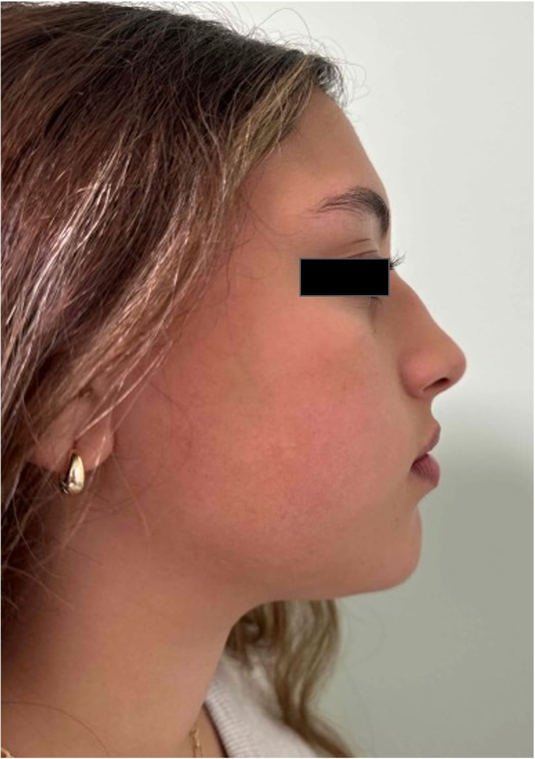 Before rhinoseptoplasty showing nasal asymmetry and a deviated septum, right side view